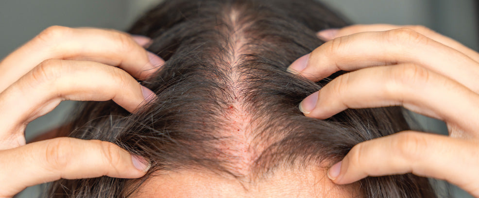 Sensitive Scalp